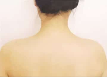 塑型及止汗-瘦肩針-after
