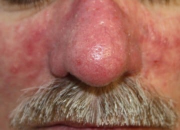 cutera-退紅激光-before2