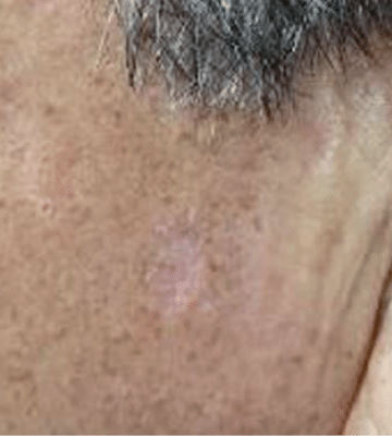 lhalala-peel-fill-after2