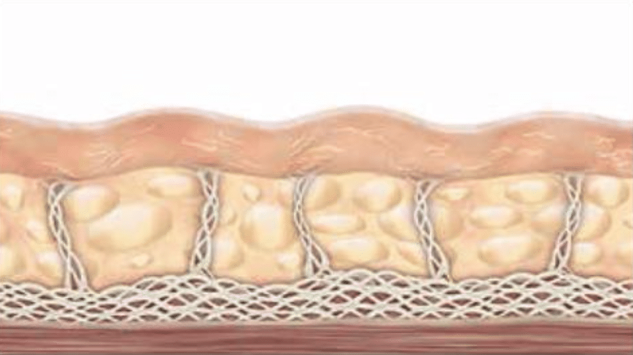 皮膚結構的示意圖,顯示脂肪層與支持結構,強調皮膚深層組織的組成。