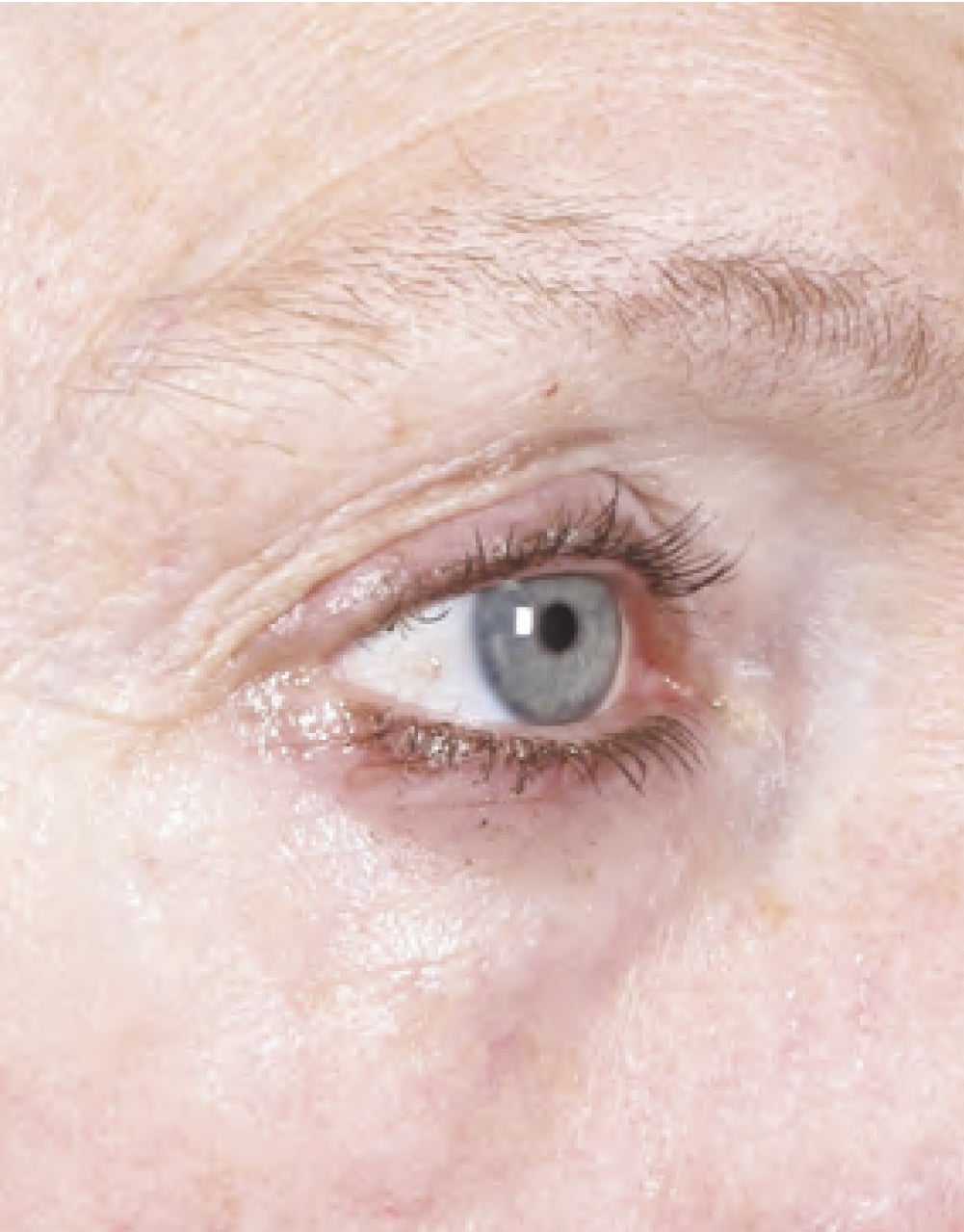 ultherapy-緊致提拉-after2