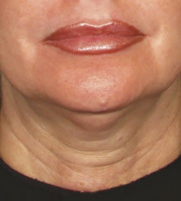 ultherapy-緊致提拉-before