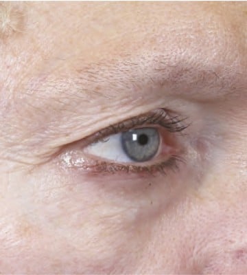 ultherapy-緊致提拉-before2