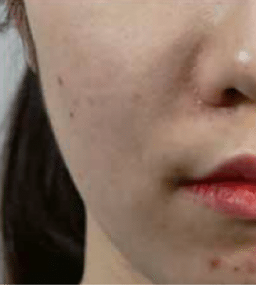 lhalala-peel-fill-before