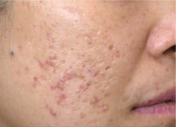 medlite-c6-納秒激光-before2