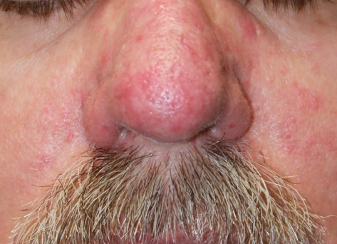 cutera-退紅激光-after2