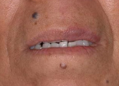 cutera-退紅激光-after