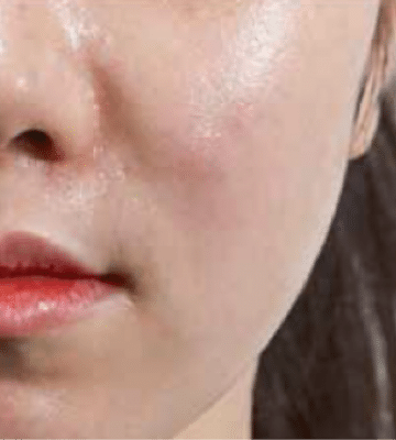 lhalala-peel-fill-after