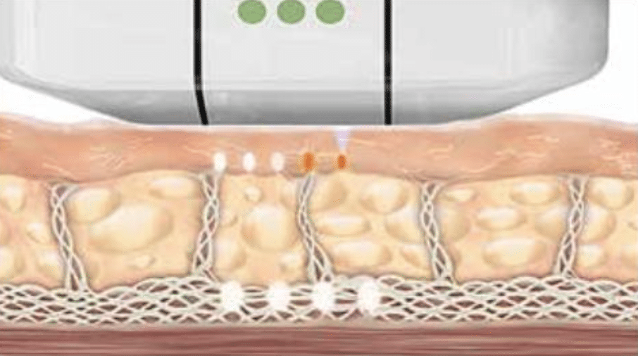 超音波治療過程中的示意圖，顯示設備對皮膚的作用，強調能量如何作用於皮膚層。