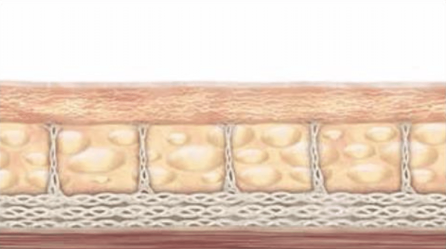 另一種皮膚結構的示意圖，展示脂肪層的特徵與結構，突顯其在美容治療中的重要性。