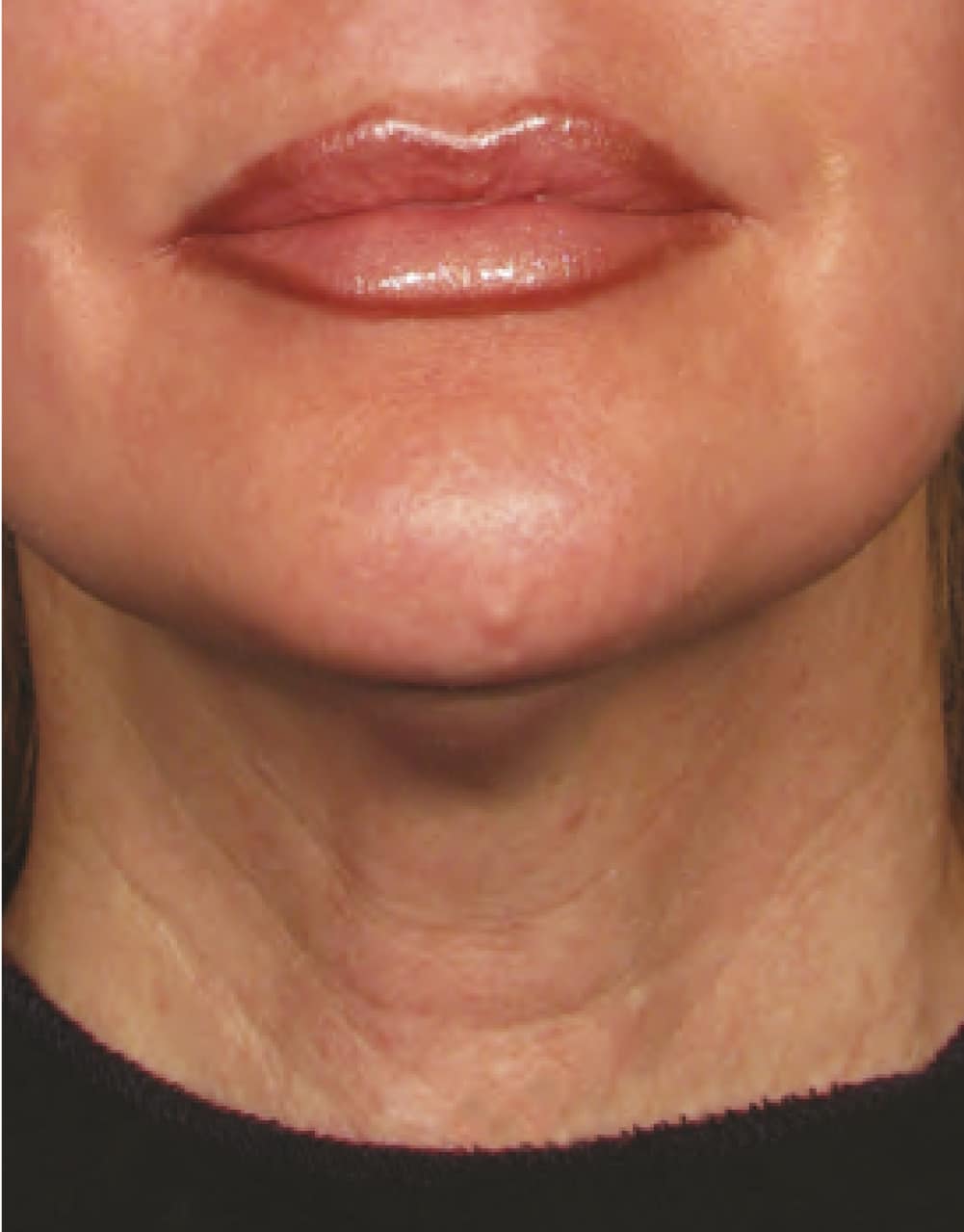 ultherapy-緊致提拉-after