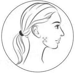 女性側面輪廓插圖,顯示皮膚上有痘痘的情況,強調面部皮膚問題,適合用於討論皮膚護理和治療方法的內容。